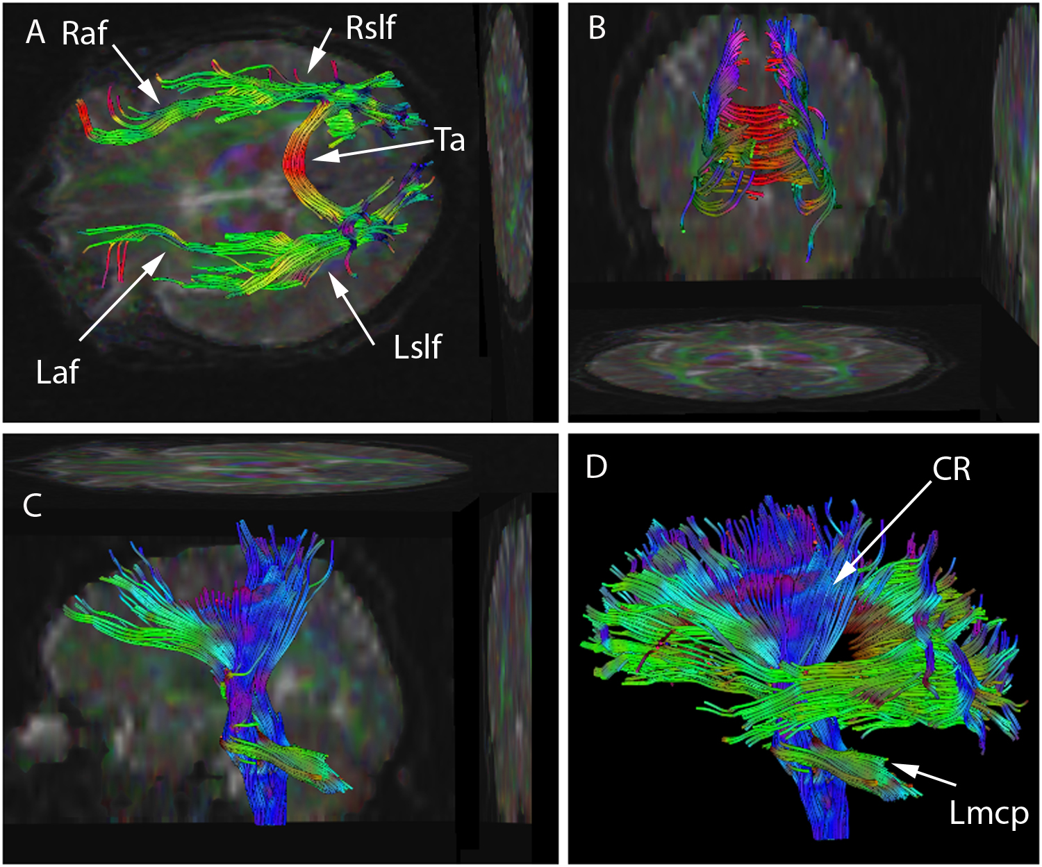 Diffusion-imaging reconstructions of the brain's fibre tracts, rendered in bands of colour by direction.