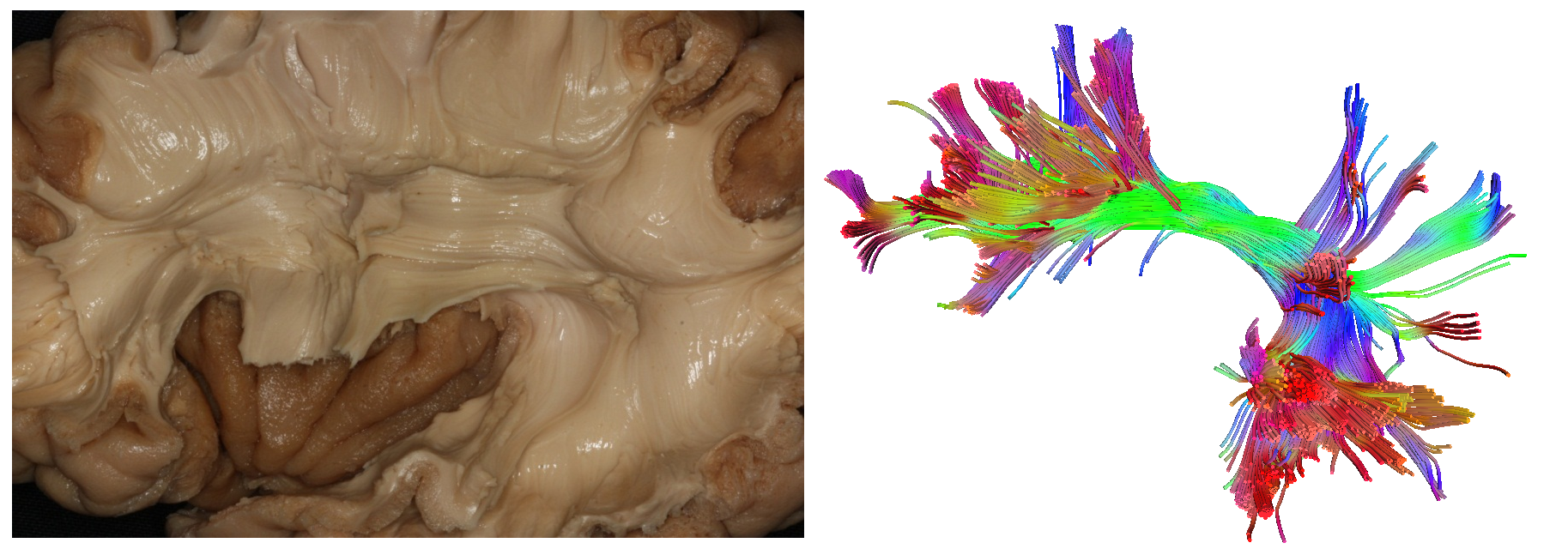 Side-by-side images of a dissected white-matter tract and the same tract reconstructed by imaging.